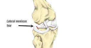 lateral meniscus tear symptoms