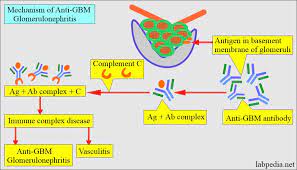 Anti Gbm Anti Anti Glomerular