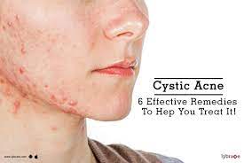 cystic acne 6 effective remes to