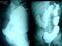 adenocarcinoma of the colon in children