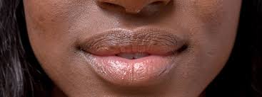 dry lips moisturized during winter
