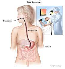 Cancer, esophageal web, or stricture • solid plus liquid dysphagia is due to esophageal motility. Gastric Cancer Treatment Pdq Patient Version National Cancer Institute