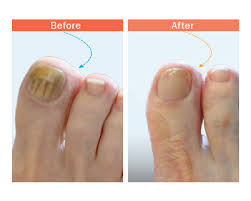 understandign toenail fungus in