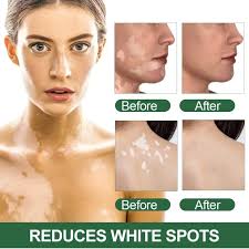 Sumifun Vitiligo Care Cream, Vitiligo Treatment, Reduces White Spots on Skin, Pigmentation regulating 20G | Daraz.com.bd