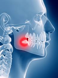 reasons for wisdom tooth removal salt