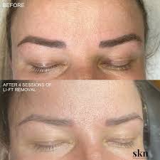 microblading removal in stone by