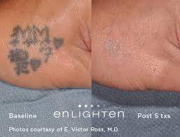 laser tattoo removal fewer treatments