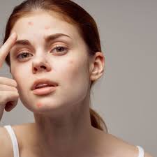 oily acne e skin