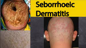 seborrheic dermais symptoms