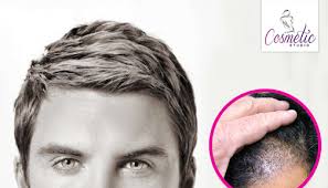 Hair weaving techniques refer to different methods to combine hair strands to make complete extension hairpieces. Hair Transplant Vs Hair Weaving