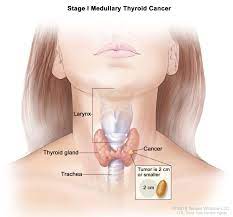 Learn about thyroid cancer symptoms and treatments. Thyroid Cancer Treatment Adult Pdq Patient Version National Cancer Institute