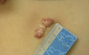 keloid removal singapore highly