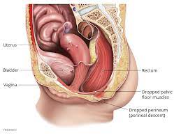 perineal descent austin urogynecology