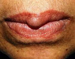 angioleiomyoma of the upper lip bmj