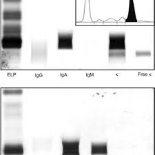 discrepancy in serum free light chain