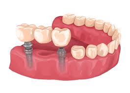 implant supported bridge lady s