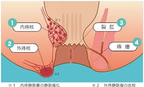痔の種類と対応（いぼ痔・切れ痔・痔ろう）： 痔の日帰り手術 | 東京・八王子クリニック