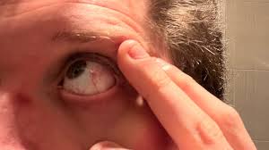 symptoms and treatment for eye bleeding