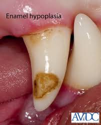 Unusual Tooth Enamel Can Be Addressed With Restoration