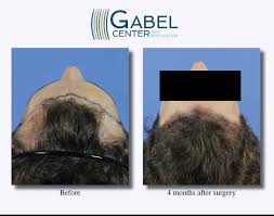 Watch A Patients Real Time Growth After 3439 Grafts Gabel