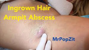 ingrown hair armpit abscess surprising