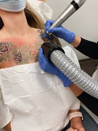 my 1st two tattoo removal sessions