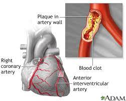 coronary heart disease medlineplus