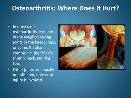 Knee Osteoarthritis   Physiopedia   Hip    
