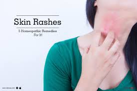skin rashes 5 homeopathic remes