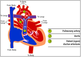 Hole in the heart is described as a congenital abnormality of the heart generally appear in the time of birth time. Congenital Heart Disease Asd Vsd Occluders Meril Life