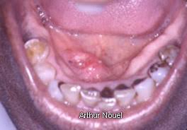 cancers of the floor of the mouth