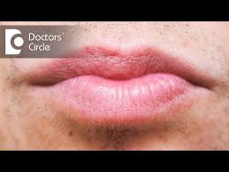 white spots in lips dr rasya dixit