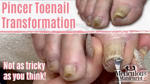 how to fix ingrown toenail pincer nails