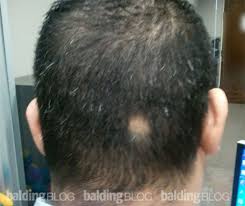 bald spot at the back of my head
