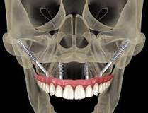 Image result for what is the cause of a person sinus to fall and a dentist lift them to put in apost