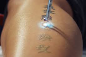 laser tattoo removal grace skincare