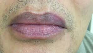 derm dx painful lip swelling crusting
