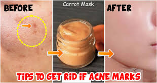 how to hide acne scars and blemishes
