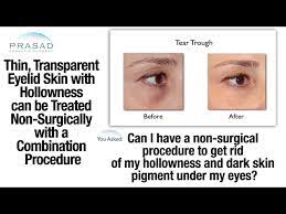 non surgical treatment for thin eyelid