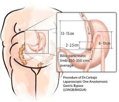 anastomosis gastric byp outcomes
