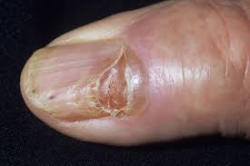 nail disorders clinical advisor