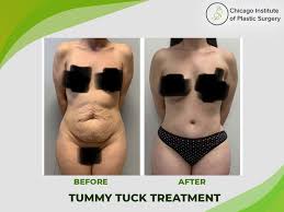 reduce your belly fat with tummy tuck