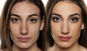 top 6 makeup tips for acne e skin