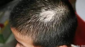 Hội chứng nghiện bứt tóc khiến con trai 3 tuổi đột nhiên rụng tóc