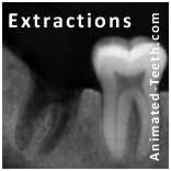 How long does a molar tooth take to heal after being pulled? Tooth Extraction Healing Timeline How Long Does It Take For Bone And Gums To Heal Pictures