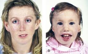A syndrome that causes various physical deformities. 27 Treacher Collins Syndrome Evaluation And Treatment Pocket Dentistry