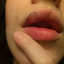 white lumps after lip injection
