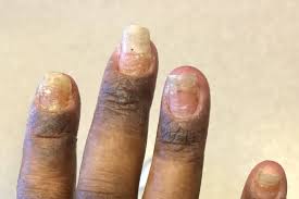 redness of the fingernail folds
