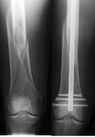 fem shaft fractures trauma