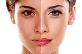Cara menghilangkan flek hitam di wajah secara alami. 5 Cara Menghilangkan Flek Hitam Secara Alami Dan Ampuh Vivanews Co Id